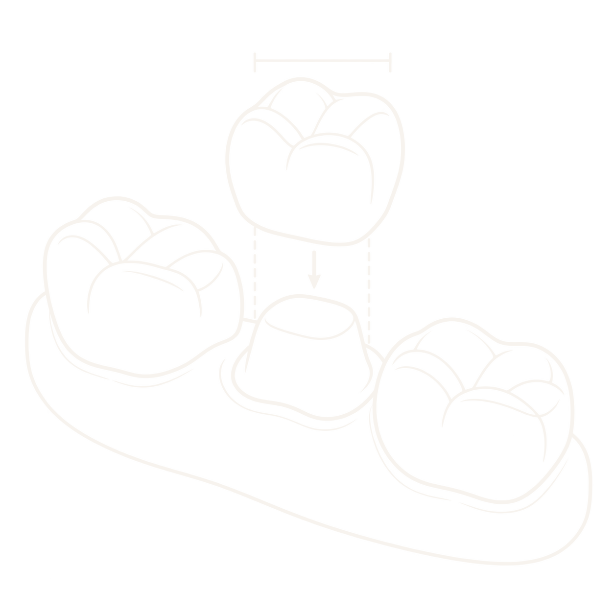 Illustration of a dental crown positioned above a prepared tooth