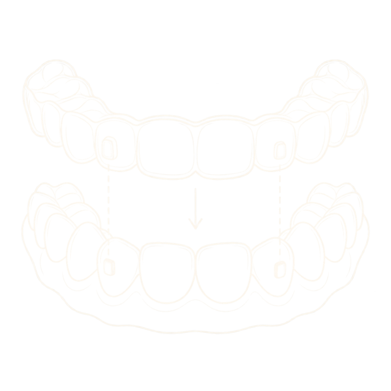Illustration of a clear aligner positioned above teeth with small attachments